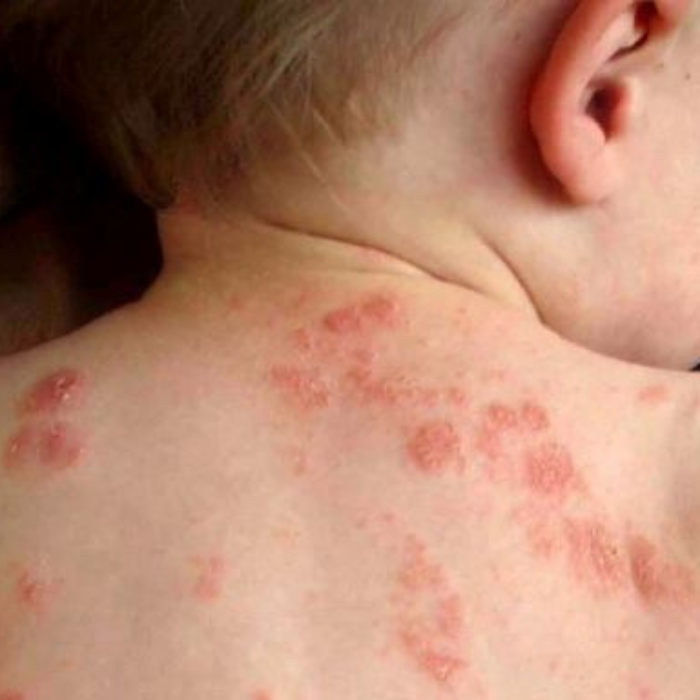Tips Mengatasi Eczema pada Bayi