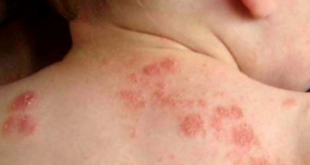 Tips Mengatasi Eczema pada Bayi